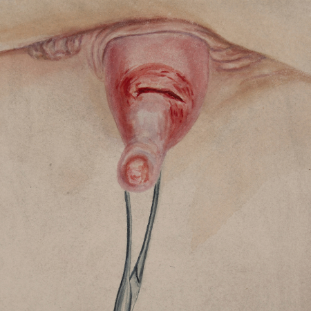 Rectal prolapse signs